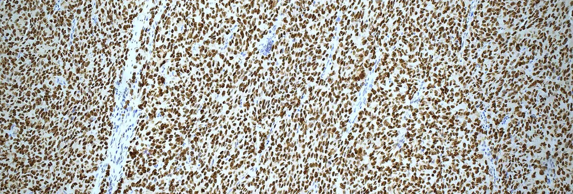 Slide image of SOX10 expression in metastatic melanoma