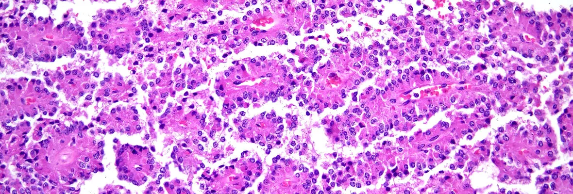 H&E slide of Solid pseudopapillary neoplasm of the pancreas