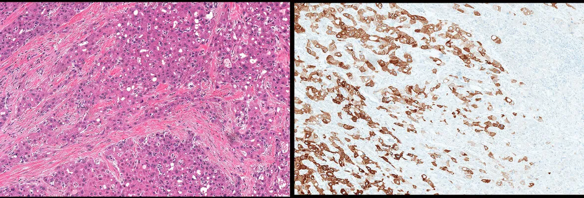 Images of slides (H&E on left, IHC on right)