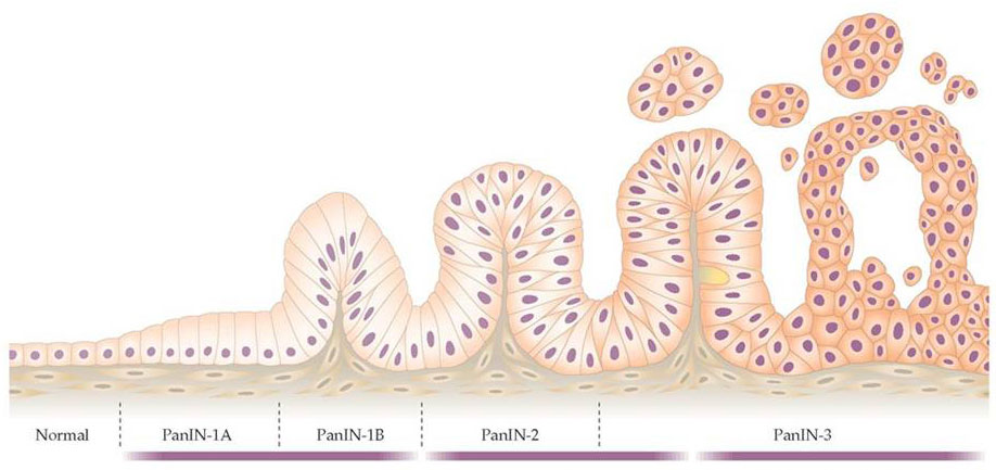 PanIN graphic