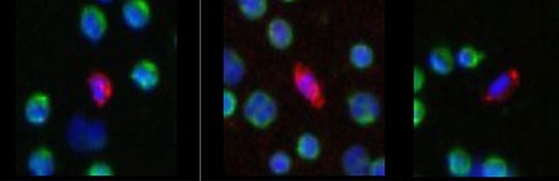 Pancreatic Cancer Patient Tumor Cells