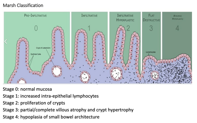The Endoscopic image of small intestinal mucosa with abnormal appearance consistent with celiac disease.