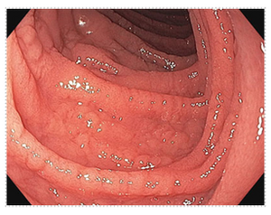 Endoscopic image of small intestinal mucosa with abnormal appearance consistent with celiac disease.