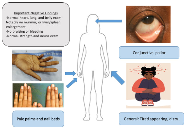 Diagram of a child with physical exam findings of anemia, including conjunctival pallor, pale palms and nail beds, and a tired, dizzy appearance, alongside normal systemic exam findings.