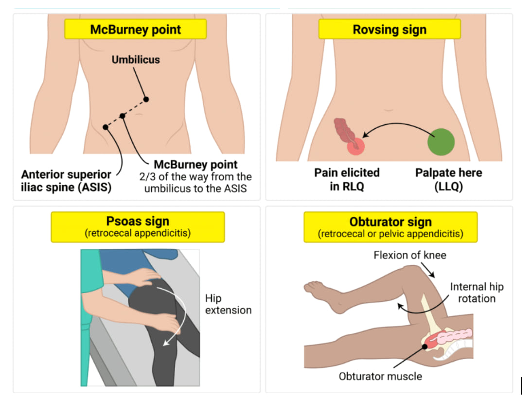 Infographic showing physical exam signs for appendicitis: McBurney point tenderness, Rovsing sign, Psoas sign, and Obturator sign.