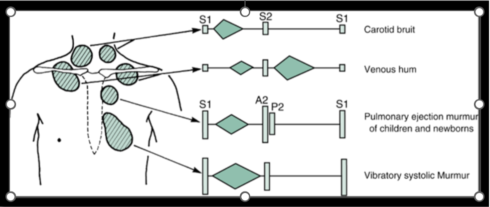 Diagram illustrating timing and auscultation locations of common innocent pediatric heart murmurs.