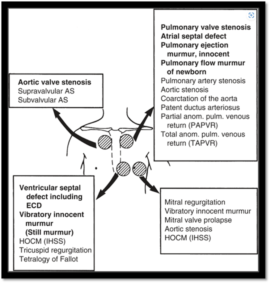 Diagram showing differential diagnoses of heart murmurs based on auscultation location.