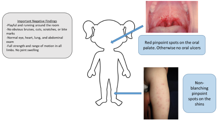 Illustration of a child with palate petechiae and non-blanching pinpoint spots on the shins, alongside normal exam findings.