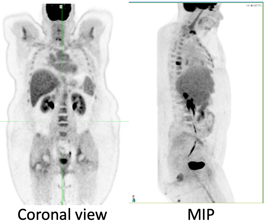 What is a PET scan? - Colontown University