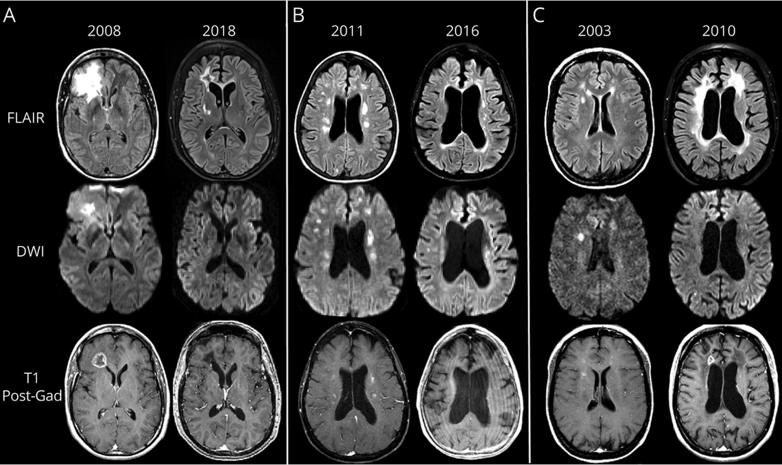 Brain lesions in RVCL