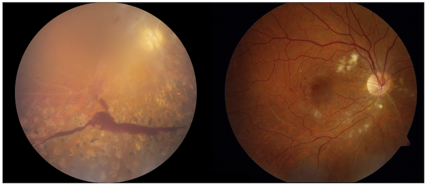RVCL eye disease