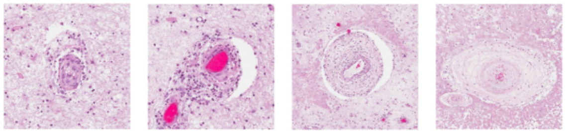 Blood vessel abnormalities observed in RVCL.