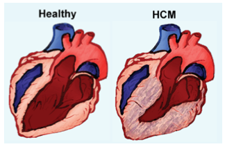 illustration of a healthy and an hcm heart