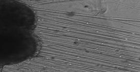 Peripheral Nerve Transplant