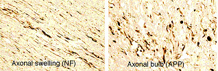 Axonal Pathology