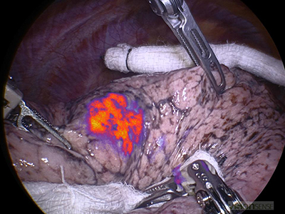 Tumor Glow robotic case in vivo fluorescent imaging