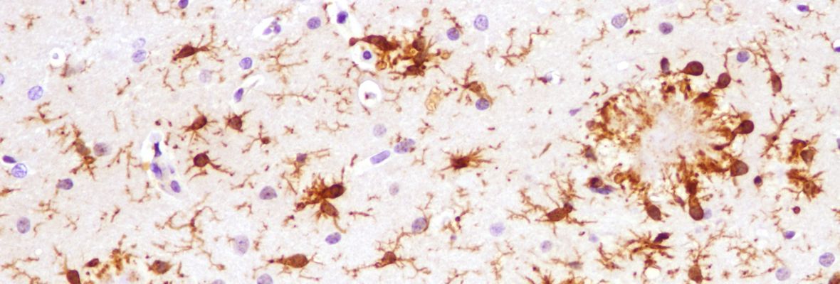 Microglia around amyloid plaque