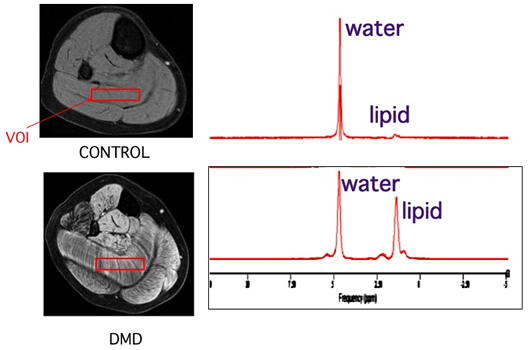 lipid infiltration